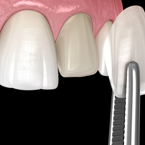 Up-close view of dental veneer