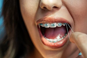 Young lady applies elastics to her braces