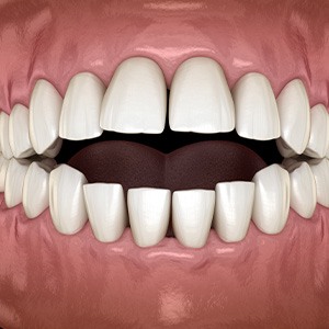 Illustration of an open bite