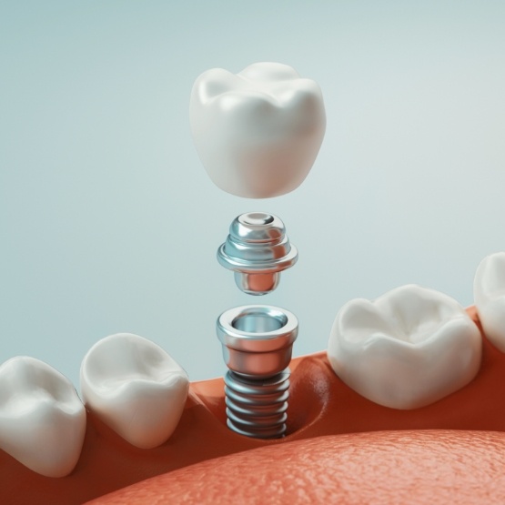Illustrated dental implant with crown and abutment being placed in lower jaw