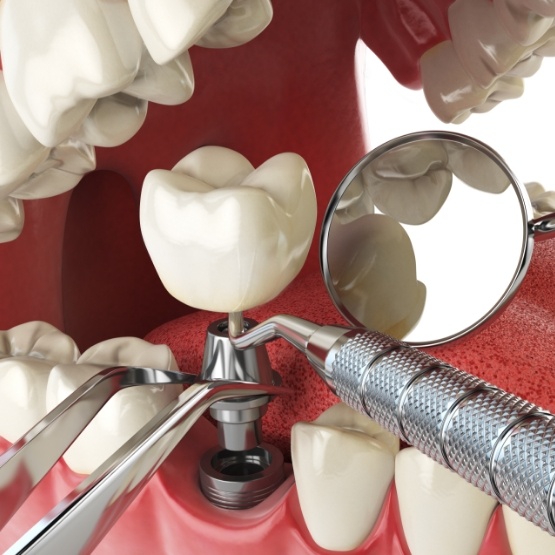 Illustrated dental implant being placed in lower jaw