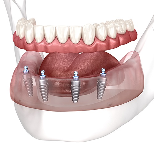 Digital image of implant dentures