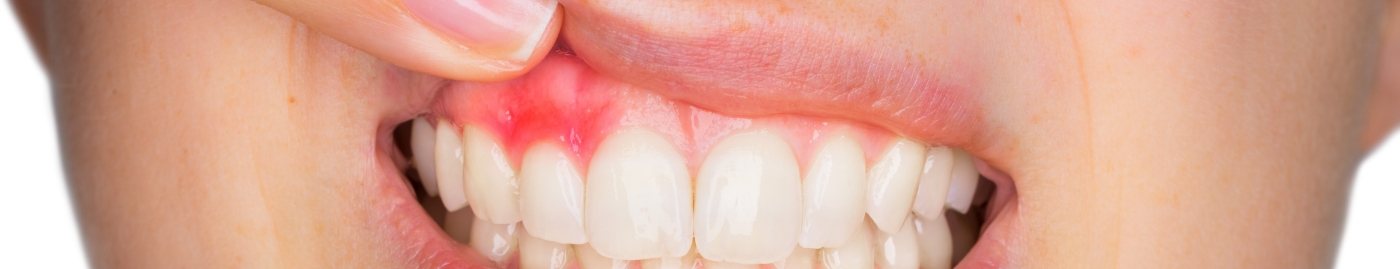 Person pointing to red spot in their gums before gum disease treatment in Albuquerque