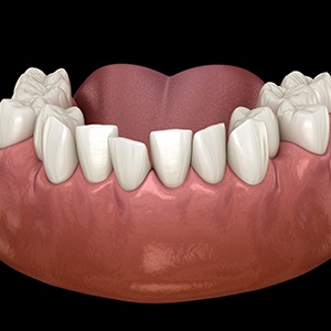 Example of tooth crowding fixable with Invisalign in Albuquerque