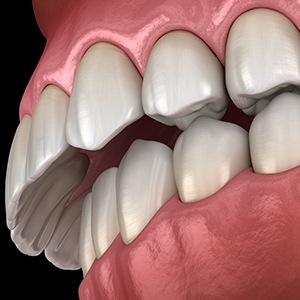 Example of an overbite fixable with Invisalign in Albuquerque