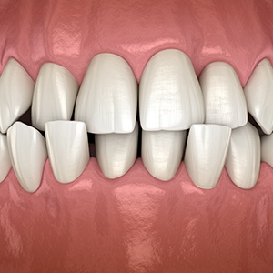 Example of a crossbite fixable with Invisalign in Albuquerque