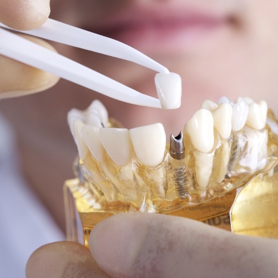 Dentist placing dental crown over a dental implant in a model of the mouth