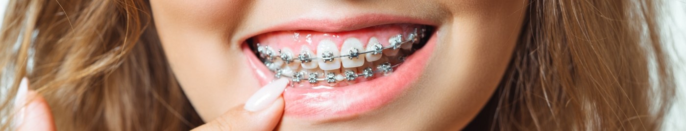 Close up of young woman with braces pointing to her smile