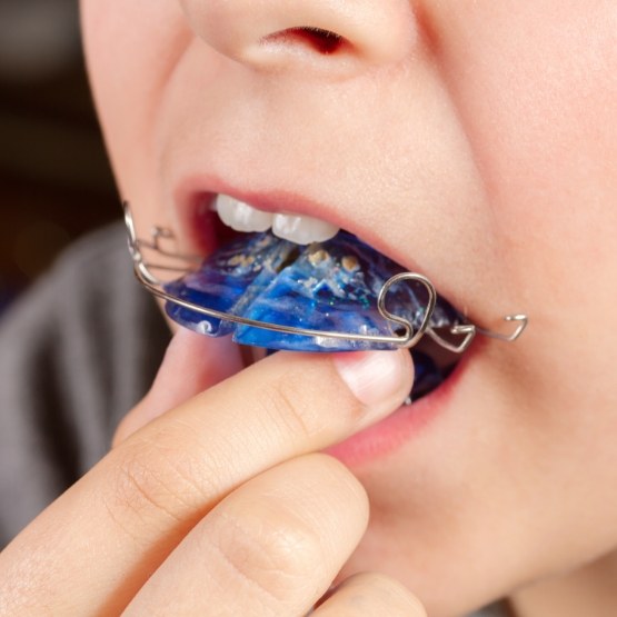 Close up of person placing a retainer in their mouth