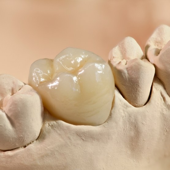 Dental crown covering up tooth in model of the mouth