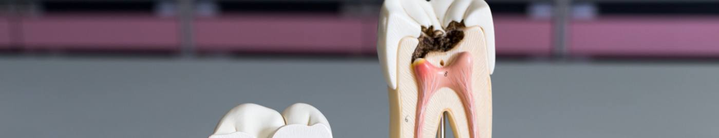 Model of decayed tooth that needs root canal treatment in Albuquerque