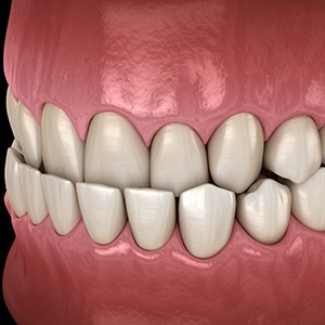 a 3D example of an underbite