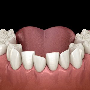 a 3D depiction of crooked and crowded teeth