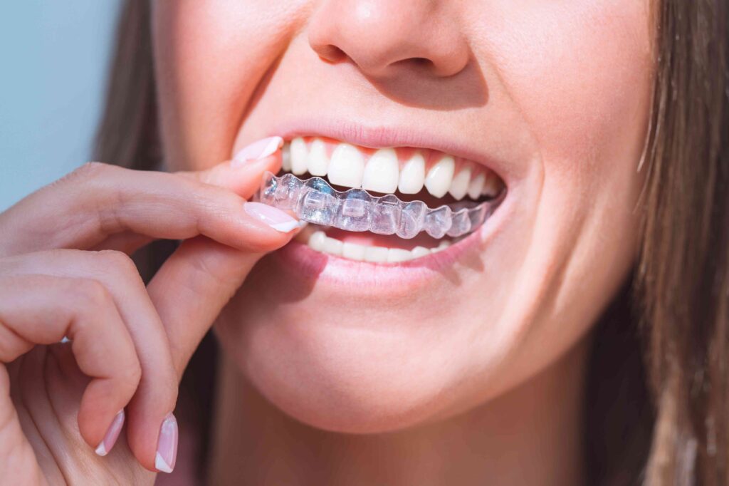 Invisalign-teeth-grinding